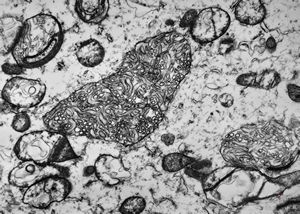 F,44y. | ependymoma